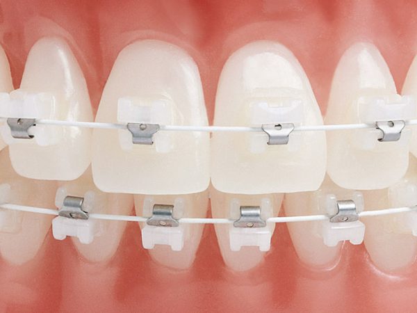 bracket-ceramico-autoligado-2