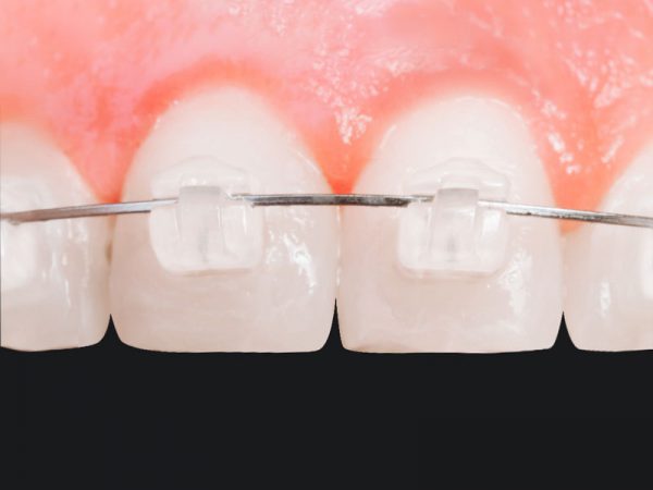 bracket-ceramico-autoligado-3