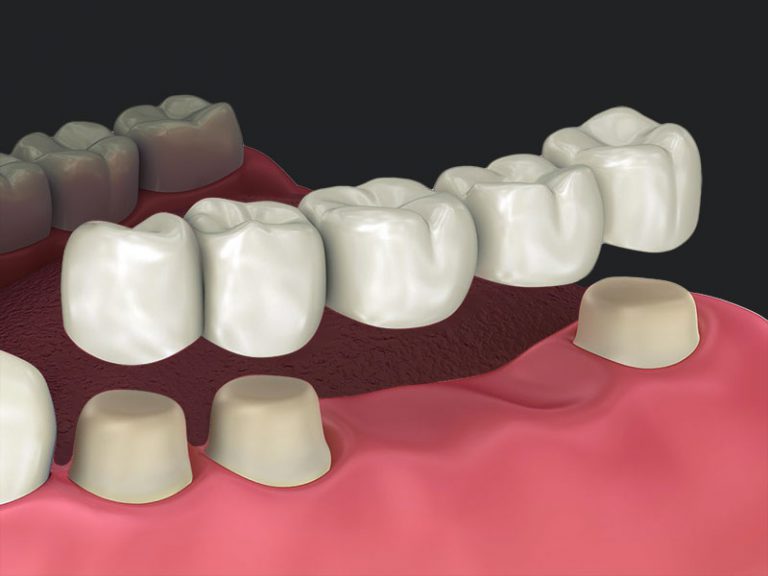PRÓTESIS DENTALES | CLÍNICA RANALLI