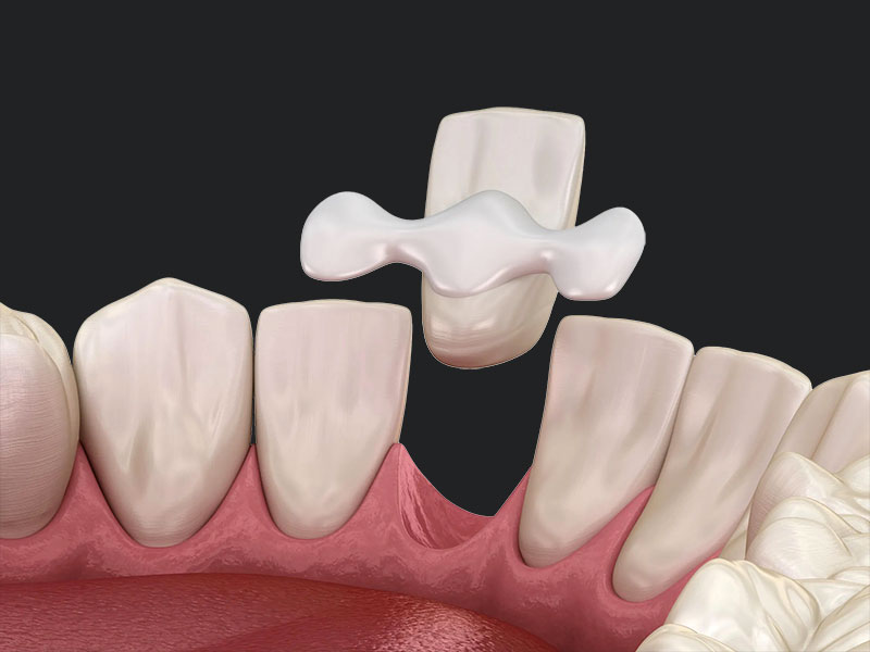 PUENTE DENTAL | CLÍNICA RANALLI